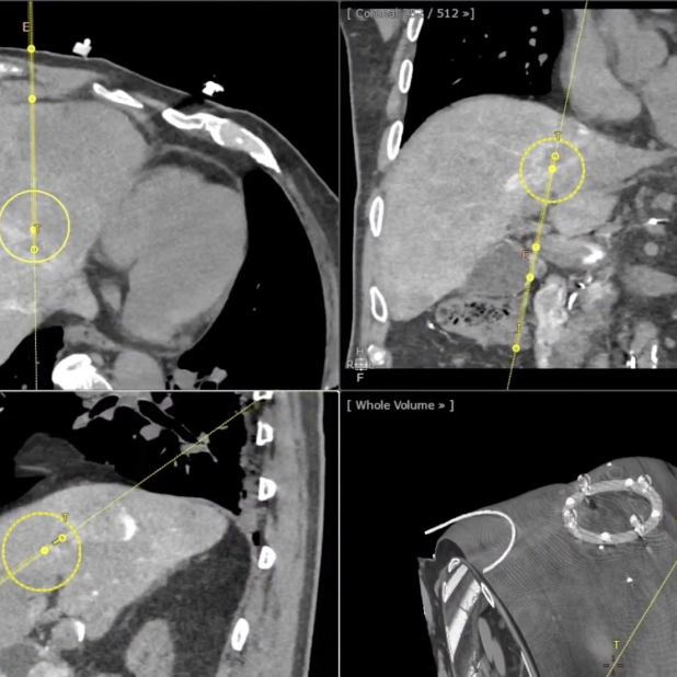 En utilisant l’IA, le robot Epione de la startup Quantum Surgical permet au chirurgien d’atteindre des tumeurs inopérables à la main et promet de révolutionner le traitement du cancer. © Quantum Surgical