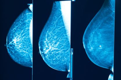 Mammographie. Crédit : Institut Curie