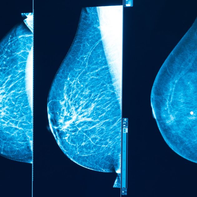 Mammographie. Crédit : Institut Curie